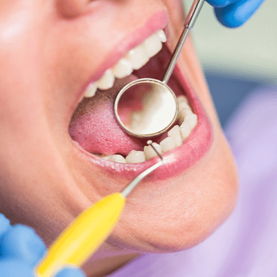 dental filling
