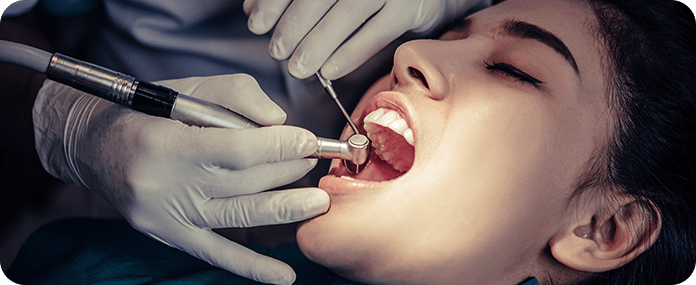root canal