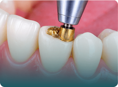 dental filling