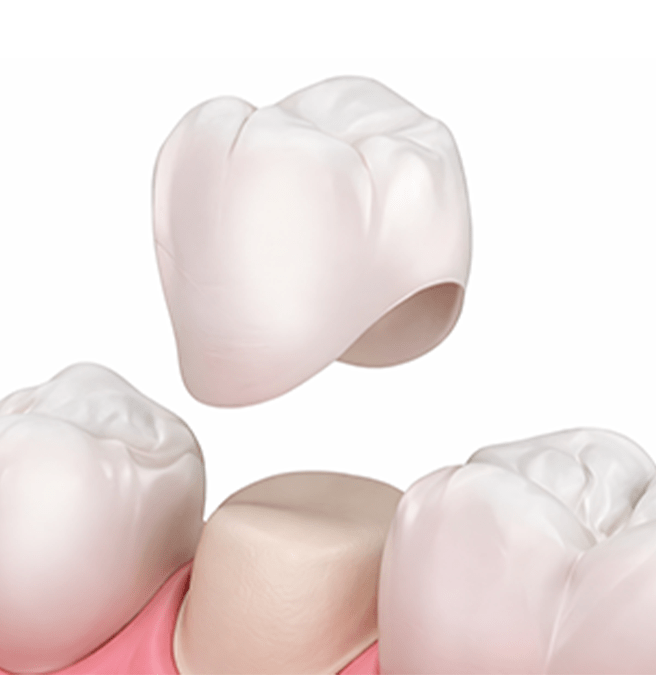 dental crowns