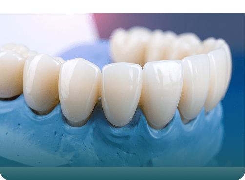 Dental Bridges in Campbellfield