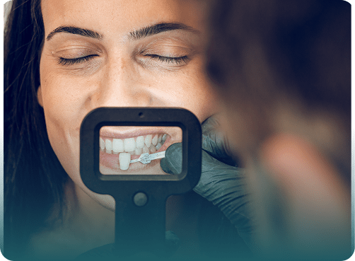 Porcelain Veneers