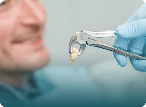 Tooth Extractions