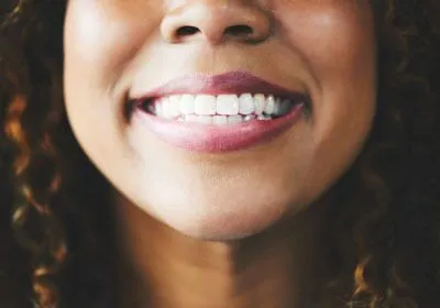 Smile Makeover