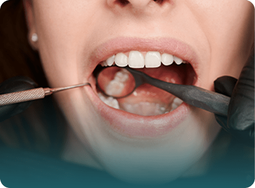 Dental Fillings