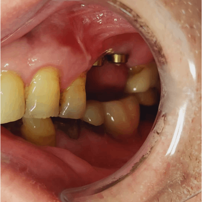 Dental Implants B Dental Implants B
