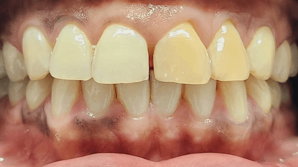 composite_bonding_Before_600x337-Claude.jpg composite_bonding_Before_600x337-Claude.jpg
